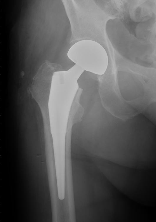 図1 人工骨頭置換術