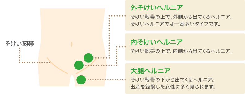 鼠径部ヘルニアとは